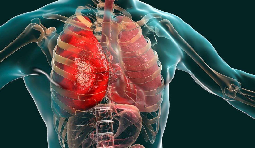 Embolia pulmonar nao é o unico risco de trombose