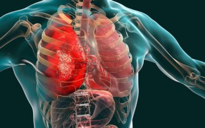 Embolia pulmonar não é o único risco de trombose