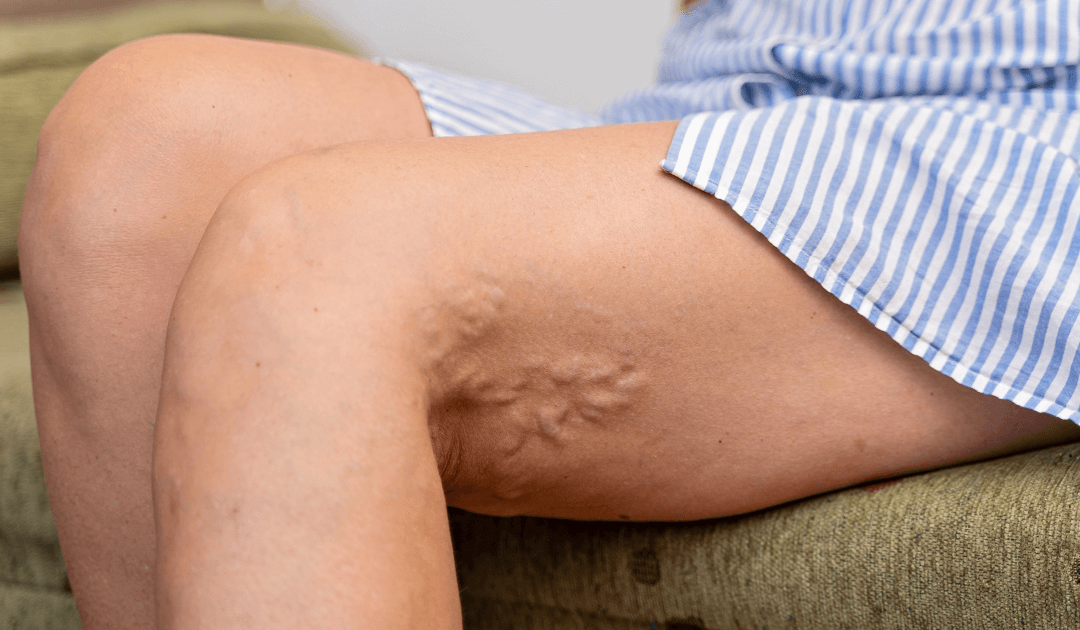 Suas varizes pioraram na menopausa?
