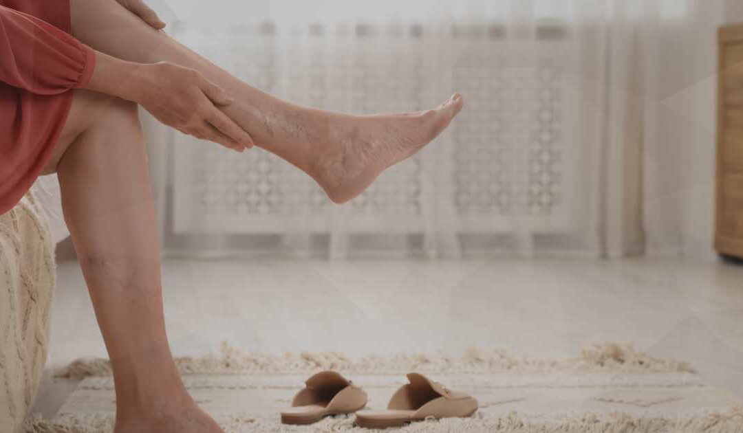 3 fatos que revolucionaram o tratamento de varizes