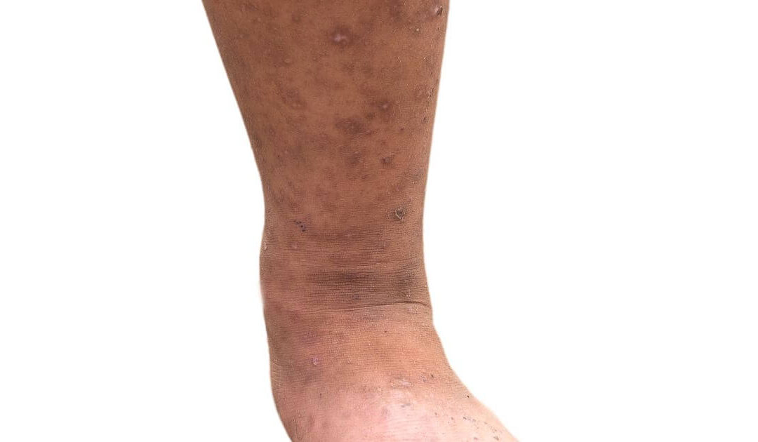 Pele morena com varizes grossas- Como evitar manchas após o tratamento