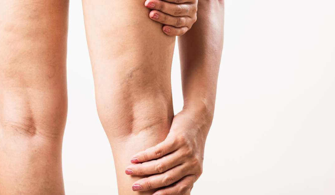 Varizes grossas são mais dificieis de tratar