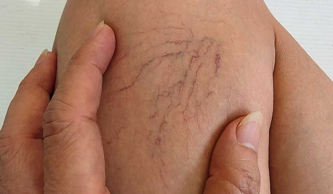 Você não precisa sofrer para tratar varizes