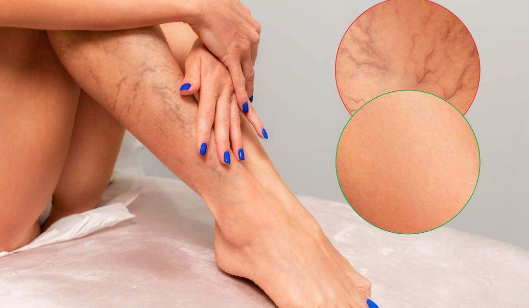 Será que meu quadro de varizes é grave?