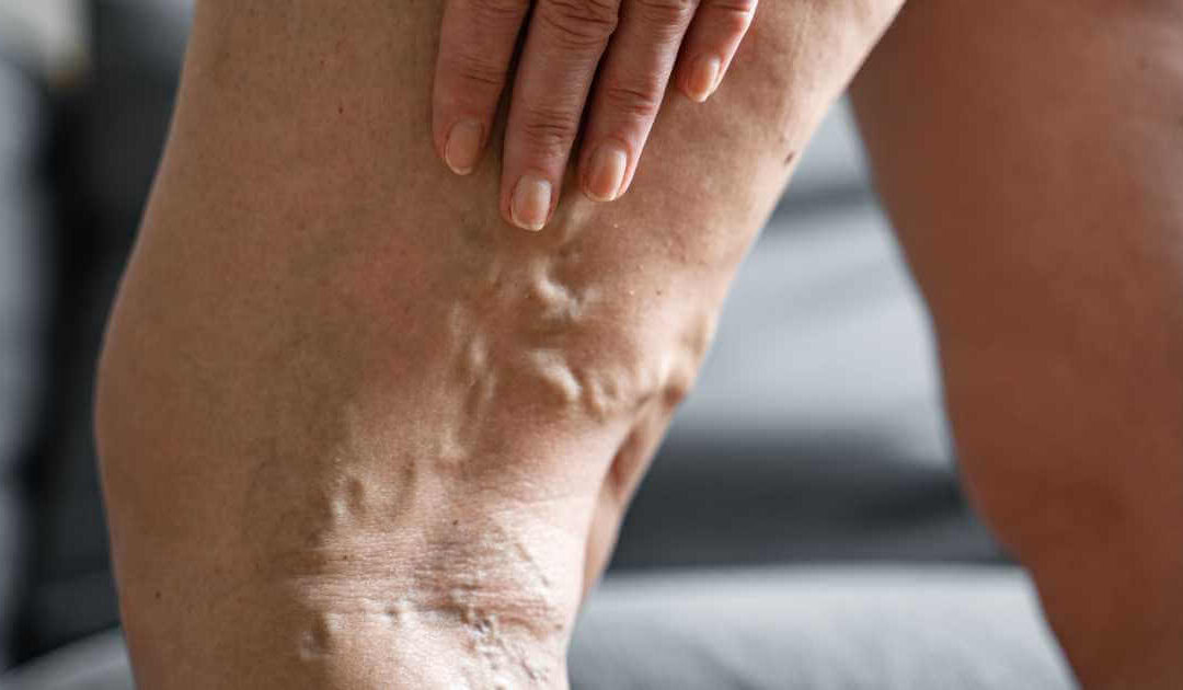 3 Complicações causadas por varizes grossas