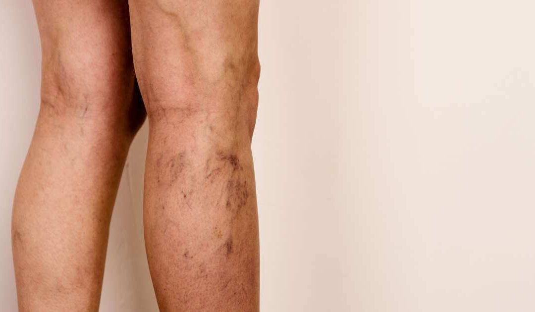 As verdades que aprendi tratando de varizes há 17 anos