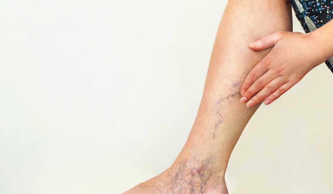 Varizes e vasinhos que doem? Cuidado!