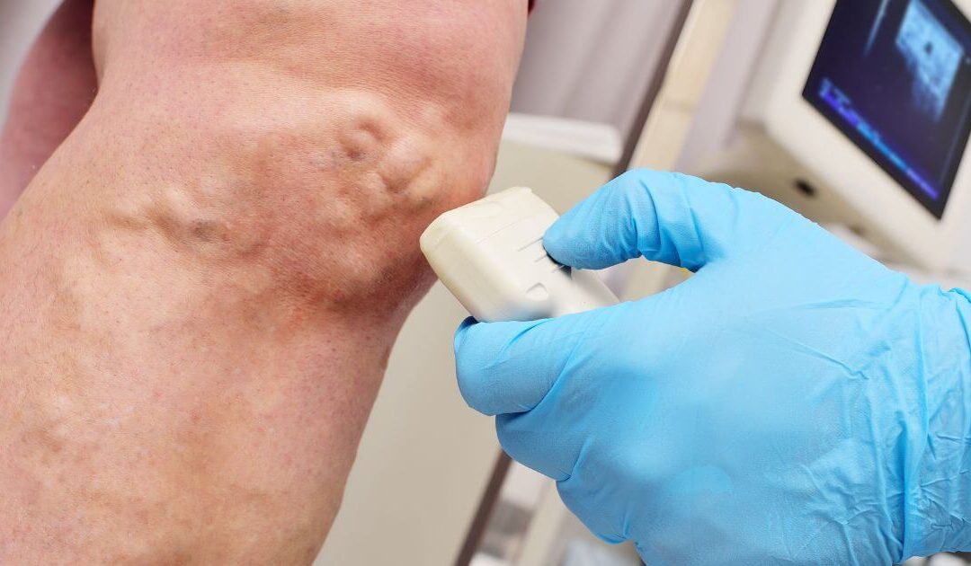 A importância do acompanhamento vascular, após a cirurgia, mesmo tendo dado certo