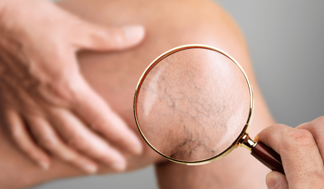 Como identificar sinais de insuficiência venosa antes das varizes aparecerem?