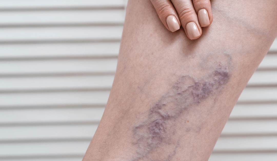 Como saber se você precisa tratar a veia de safena ou apenas os vasinhos?