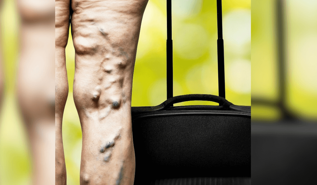 Viagens Longas e trombose, quanto tempo no avião já é considerado risco?