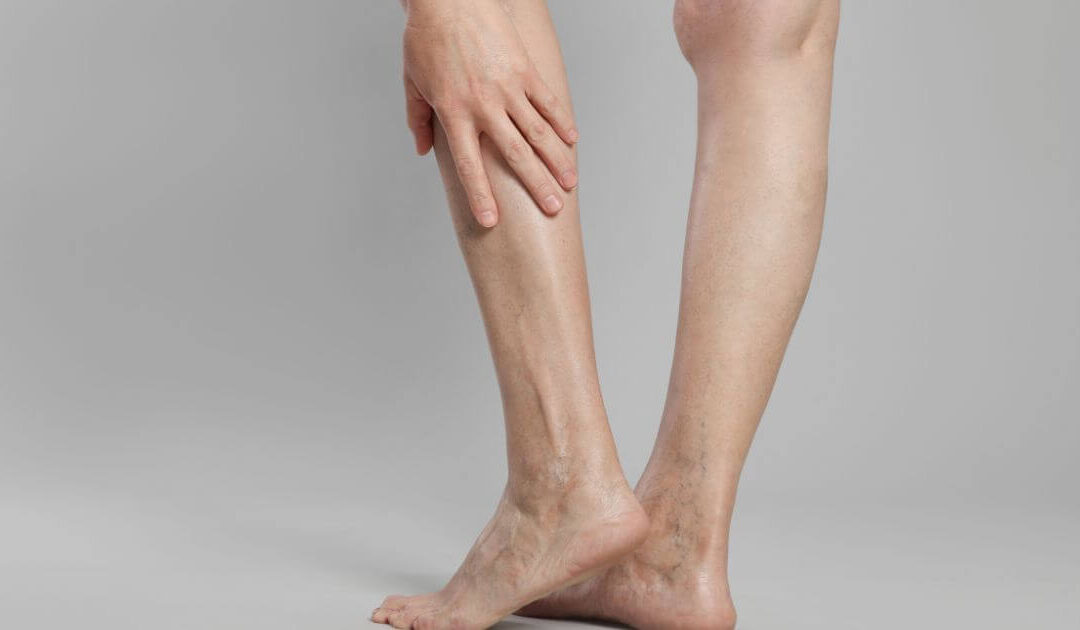 A meia elástica não funcionou ? Veja o que pode estar por trás disso