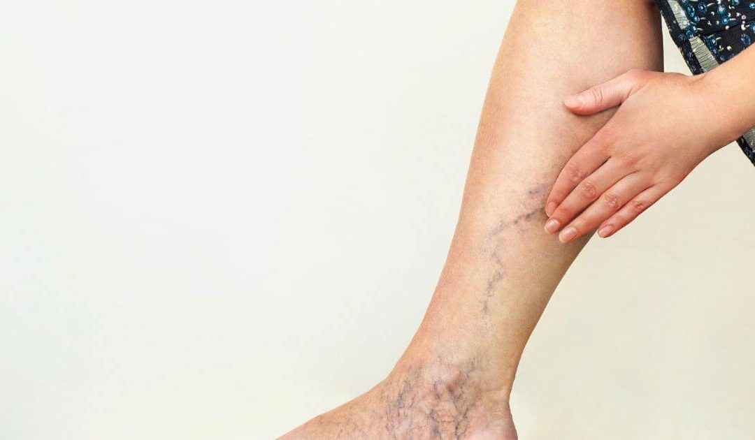 Endolaser espuma ou laser transdérmico