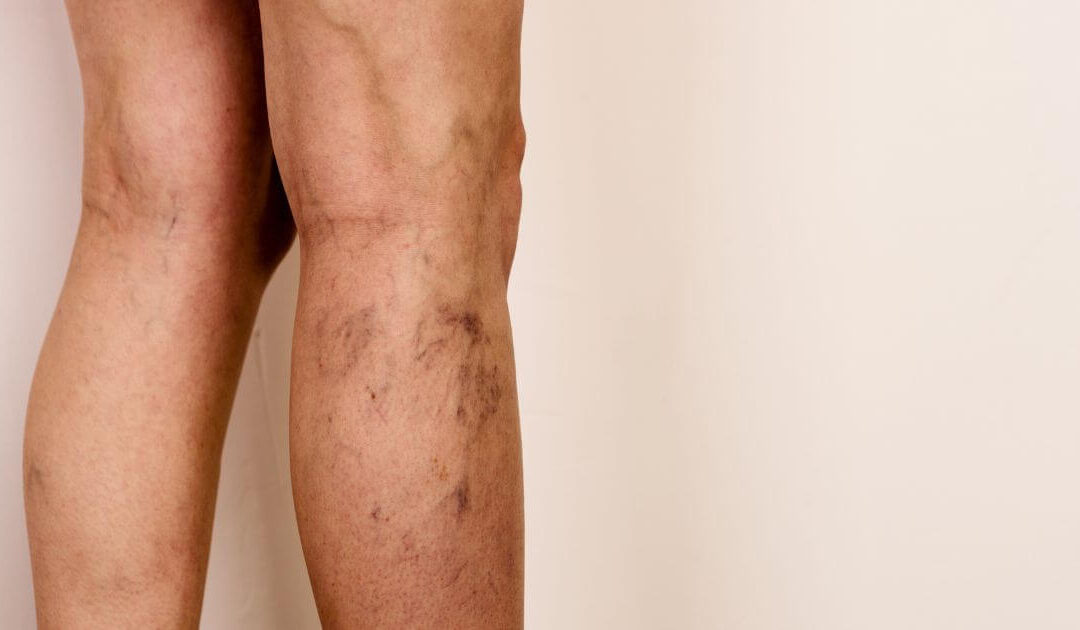 O que muda nas veias de quem ganhou ou perdeu muito peso rapidamente