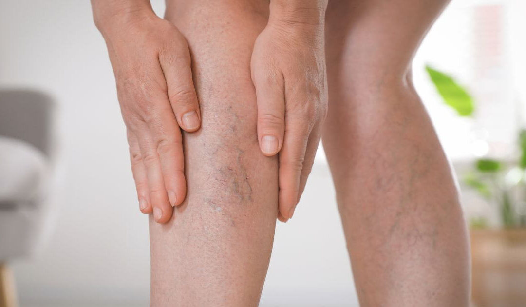 Terapia de reposição hormonal e varizes e trombose