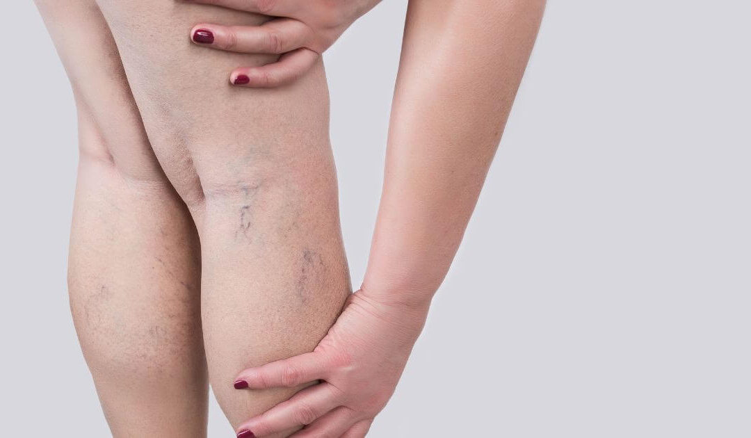 Sensação de peso nas pernas mesmo sem varizes aparentes