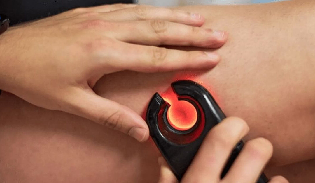 Tratamento de varizes com endolaser: sem cortes e sem internação