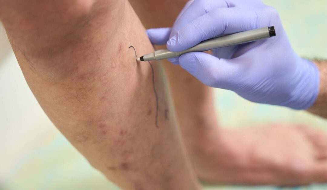 O erro mais comum após a cirurgia de varizes que pode comprometer o resultado