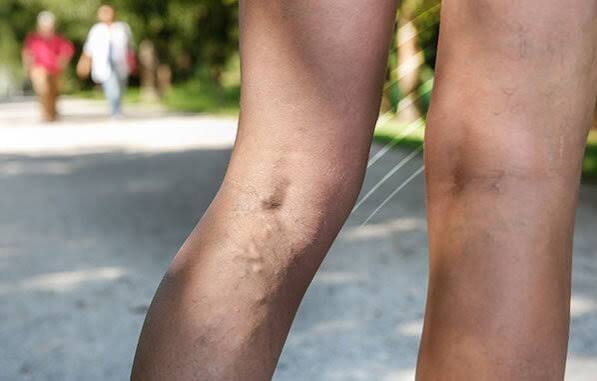 Varizes doloridas e endurecidas: pode ser tromboflebite superficial?
