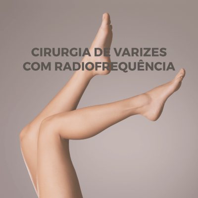 cirurgia-de-varizes-com-radiofrequencia