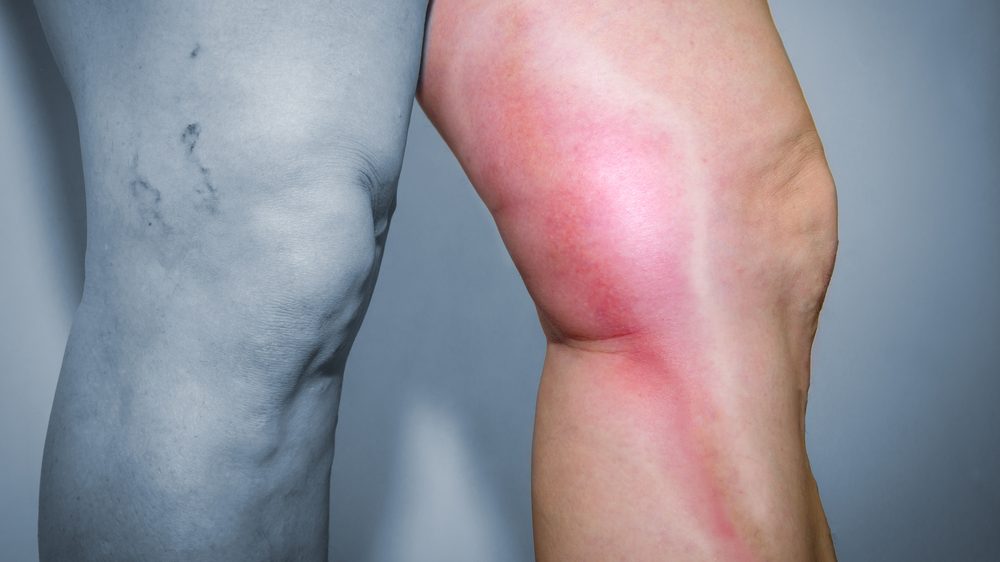 tromboflebite